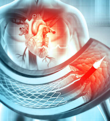 Stent and catheter for implantation into blood vessels. 3d illustration