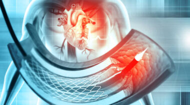 Stent and catheter for implantation into blood vessels. 3d illustration